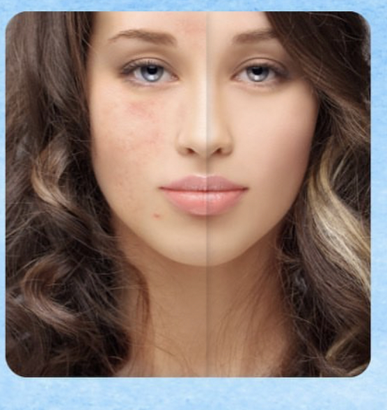 Hiperandrogenismo y Acné